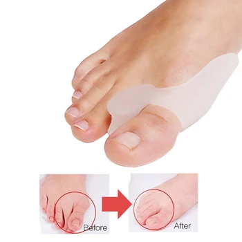 1Pair Silicon de la Picioare Separator de Inflamație la picior Os Ectropion de Reglare de la Picioare Exterioare Aparat Picior de Îngrijire Instrumente Hallux Deget de la picior de Sprijin de Îngrijire de Picioare